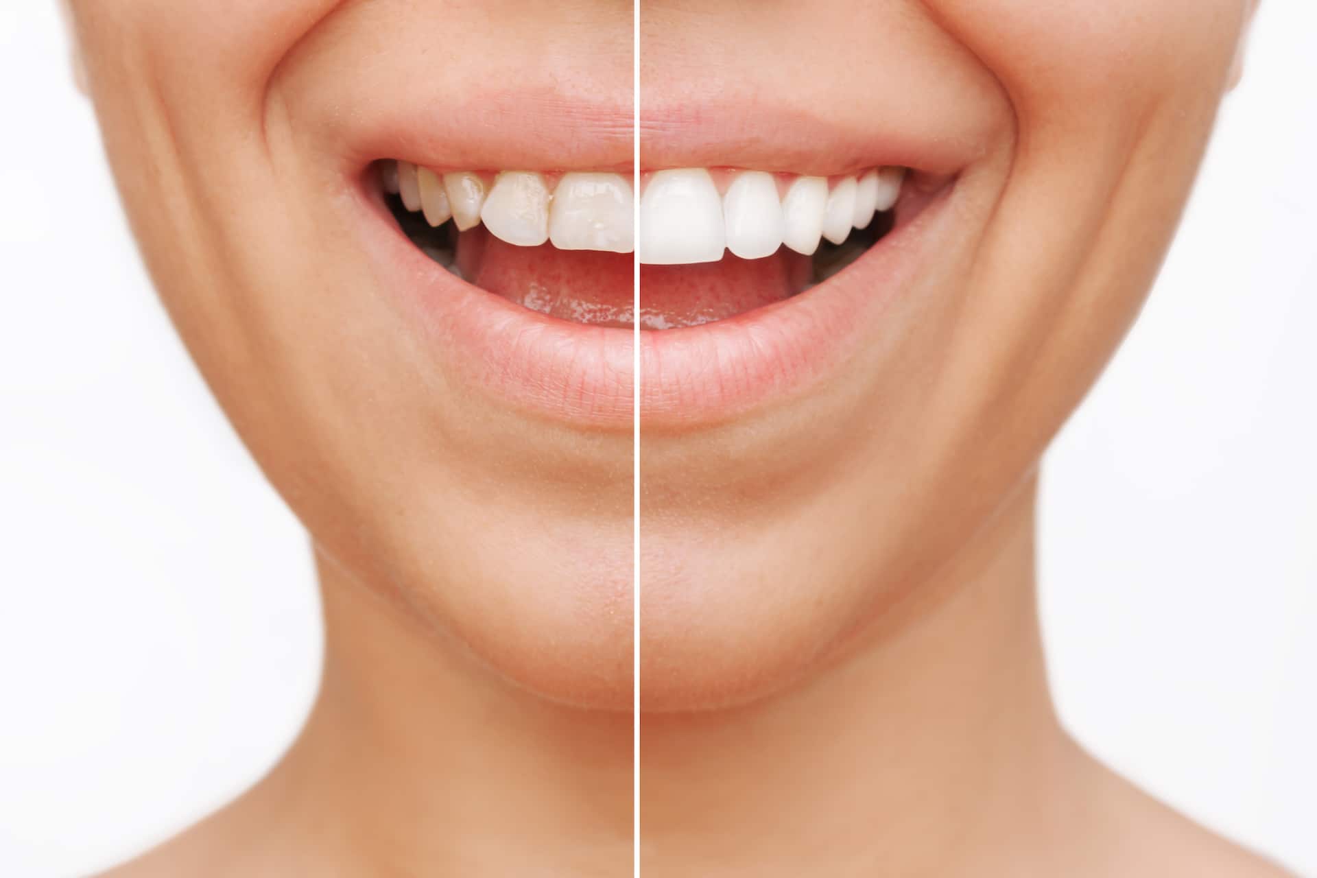 Before and after veneers cosmetic dentistry treatment.